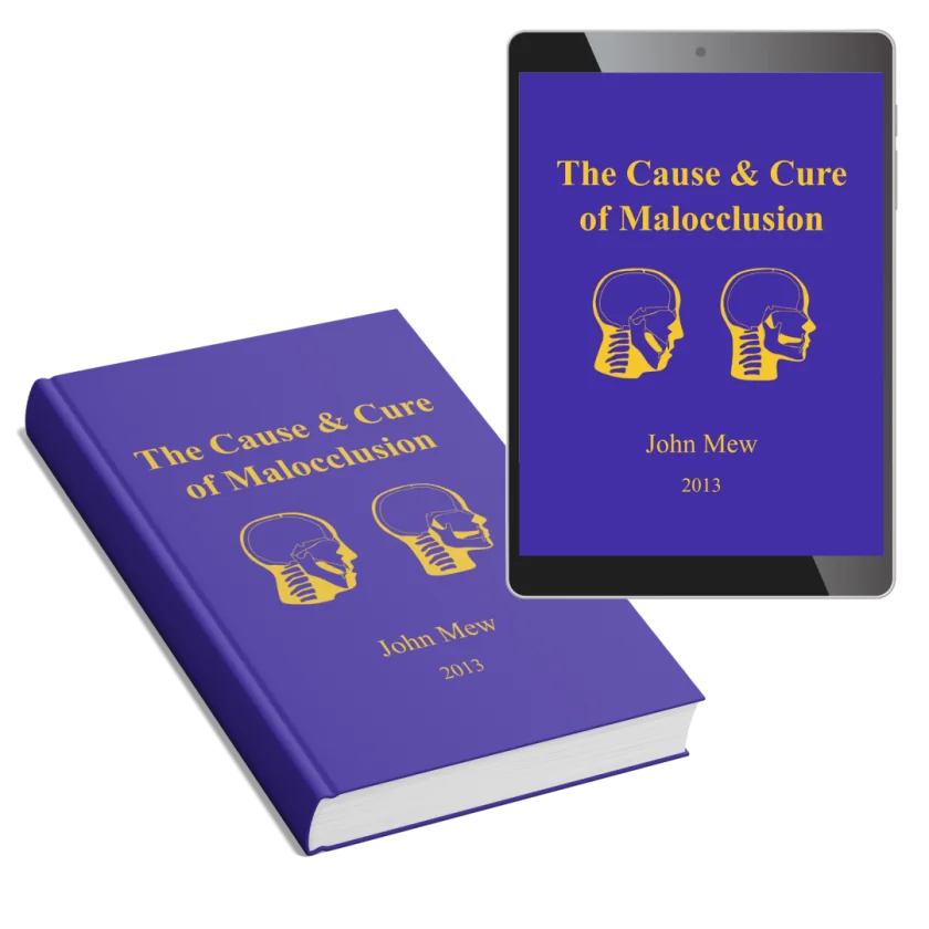 The Cause & Cure of Malocclusion by Dr. John Mew, 2013 edition — hardcover and ebook